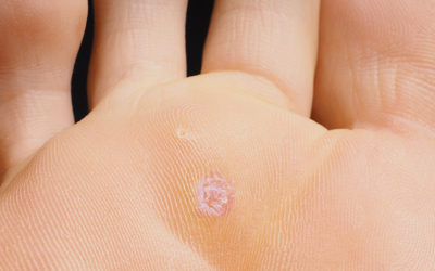 Let’s Talk Plantar Warts