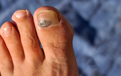 Toe Trauma