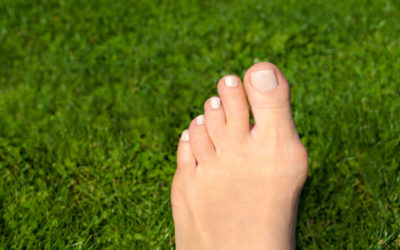 Don’t Let Bunions Ruin Your Summer