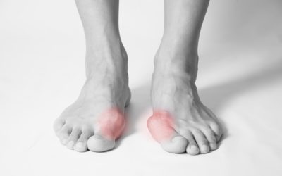 7 Simple Treatments for Bunions