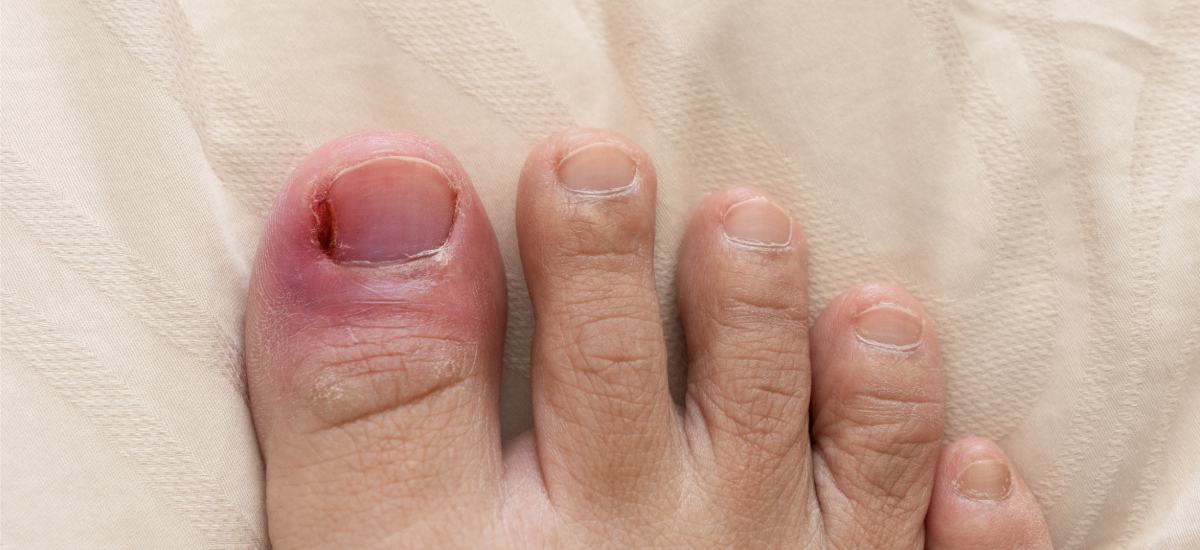 Ingrown Toenails Treatment