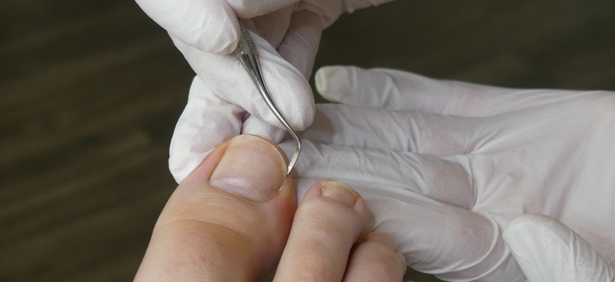 Ingrown Toenails Treatment  Foot Doctor North Andover, MA 01845 and  Tewksbury, MA 01876