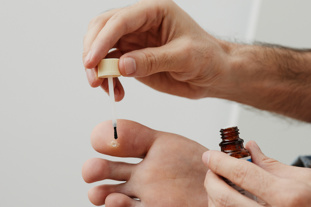 Man,Applying,Liquid,On,The,Wart,Of,His,Foot.,Home Topical Treatments