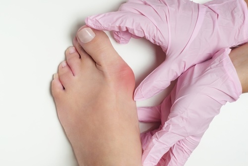 bunion surgery