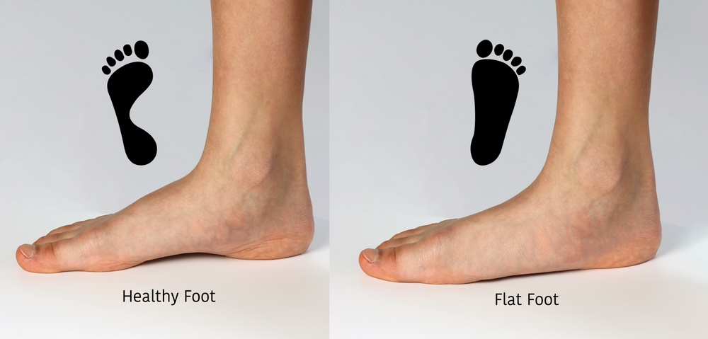 Flat Foot vs Healthy Foot