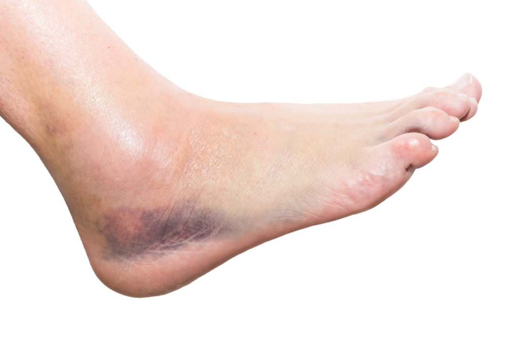 Bruised foot and ankle