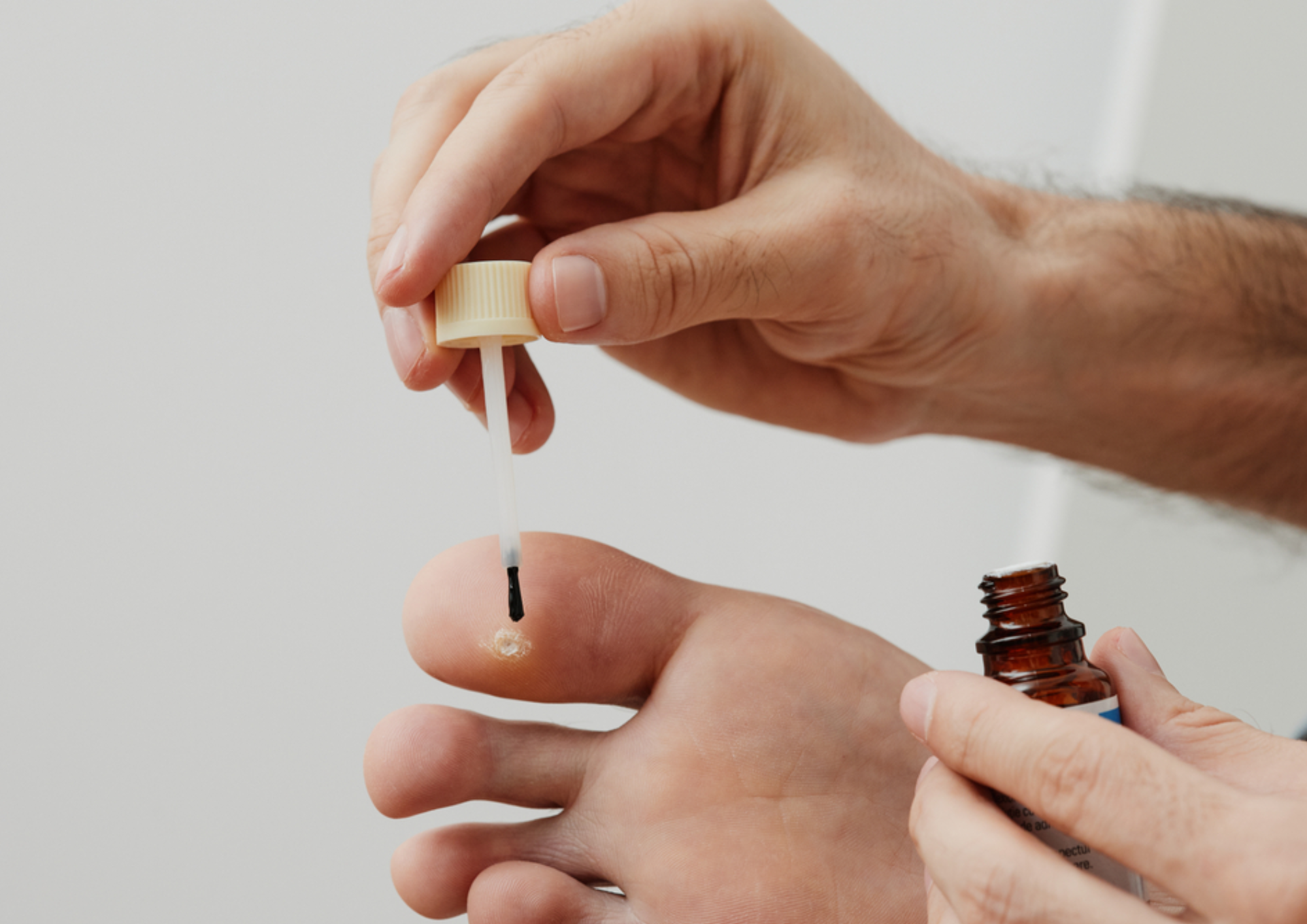 Neuroma