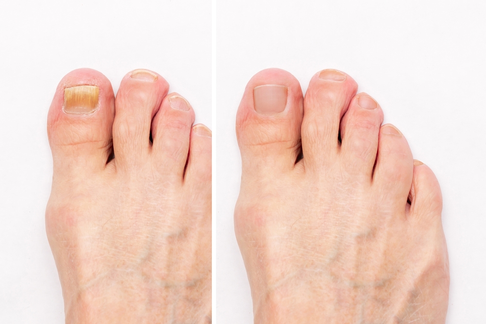 toenail fungus comparison
