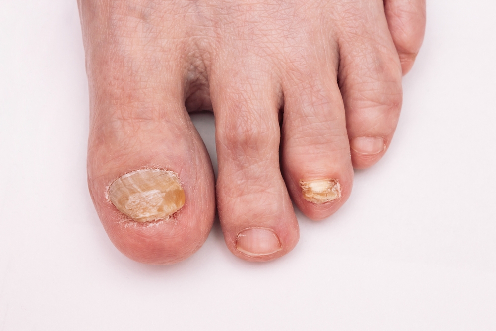 toenail fungus up close